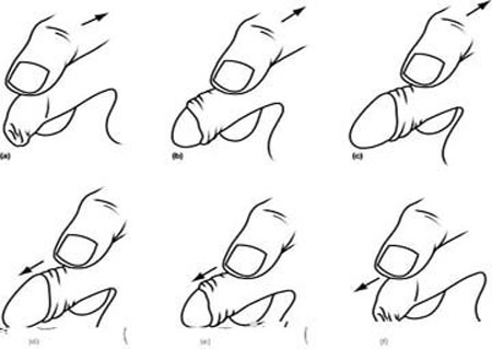 cách tự lột bao quy đầu tại nhà