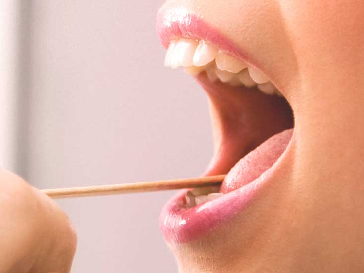 hình ảnh sùi mào gà ở lưỡi và cuống lưỡi
