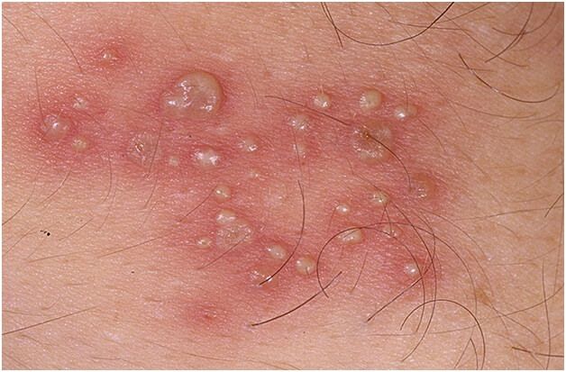 hình ảnh mụn rộp sinh dục giai đoạn đầu ở vùng kín