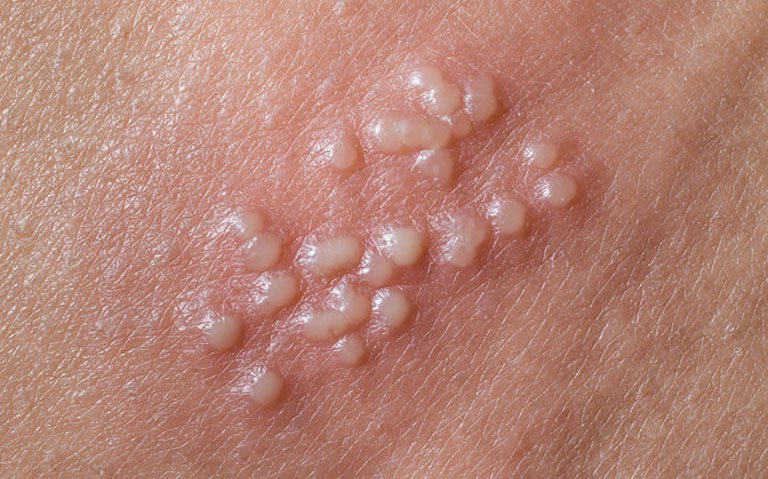 hình ảnh mụn rộp sinh dục giai đoạn đầu