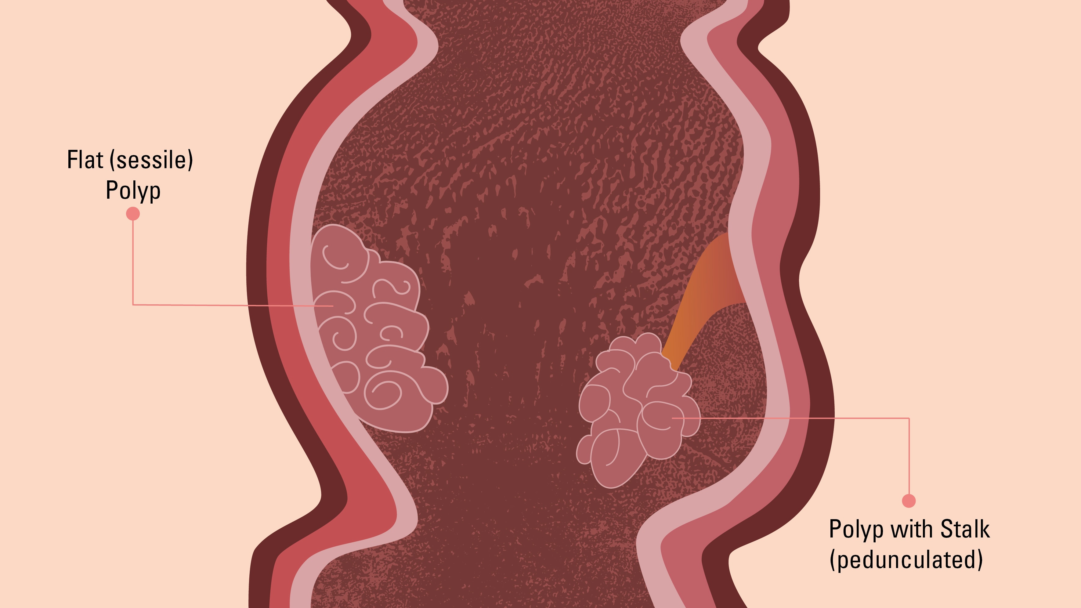 Hình ảnh Polyp hậu môn ở nam và nữ giới