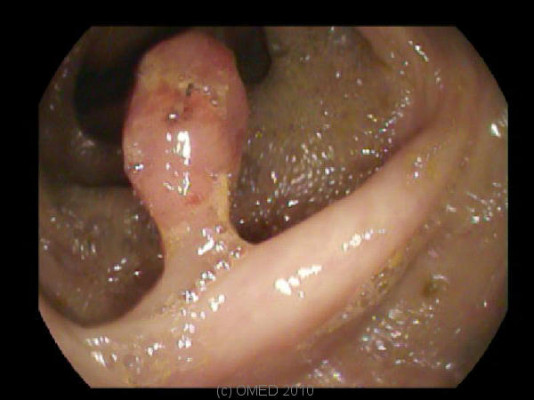 hình ảnh polyp hậu môn ở nam và nữ giới chi tiết nhất