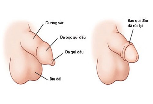Bật mí nơi tư vấn phẫu thuật cắt bao quy đầu ở nam không đau, đảm bảo và an toàn