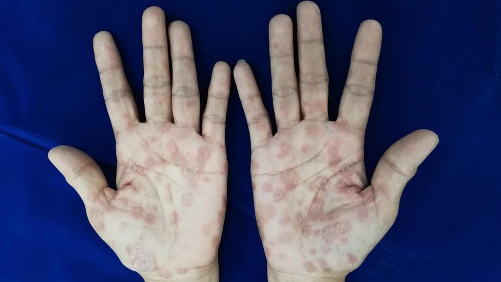 hình ảnh bệnh da liễu ở nam giới