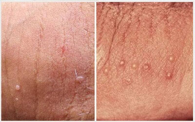 Tư vấn sùi mào gà ở nam giới