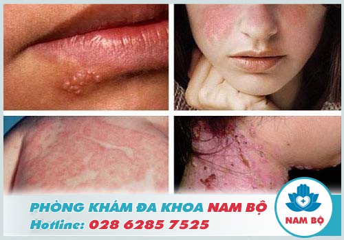 Bật mí nơi tư vấn cũng như thăm khám bệnh da liễu chất lượng