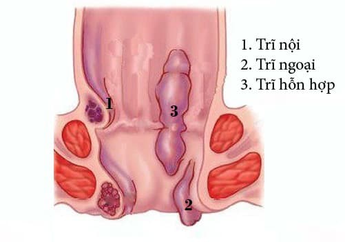 Địa chỉ chữa bệnh trĩ tại TPHCM hiệu quả không đau
