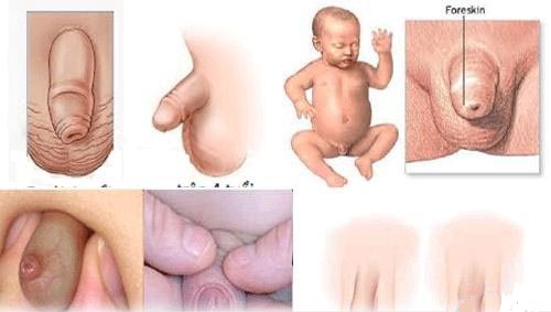 Hình ảnh dài hẹp bao quy đầu
