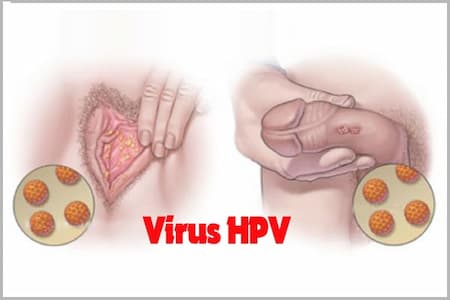 Hình ảnh bệnh sùi mào gà ở nam giới và phụ nữ