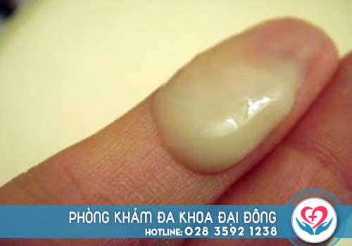 Tinh trùng vón cục có màu vàngf