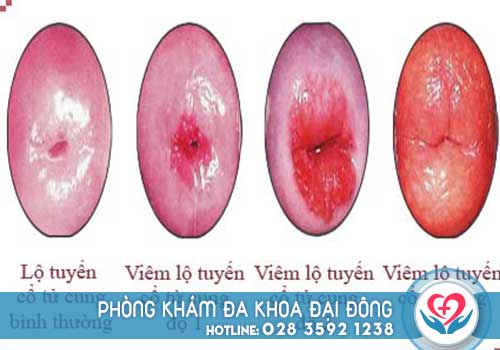 Ra máu sau khi đốt viêm lộ tuyến cổ tử cung