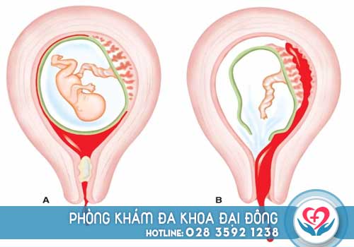 Uống thuốc phá thai xong khi nào có kinh lại