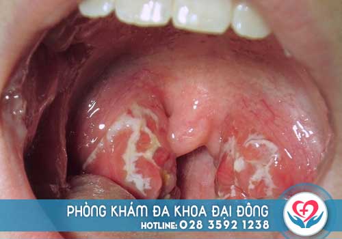 Cổ họng có mùi hôi tanh