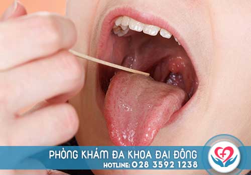 Đau họng khó nuốt nước bọt là gì