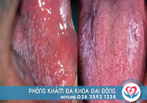 Nổi mụn trắng trong miệng không đau