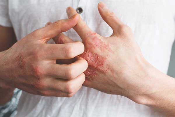 Con đường lây nhiễm bệnh giang mai