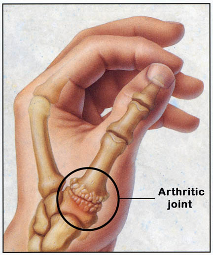 Hand Basal Joint Arthritis Decatur Orthopedica Center IL 
