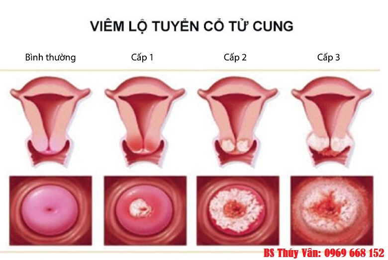 Hình ảnh viêm lộ tuyến cổ tử cung ở từng giai đoạn