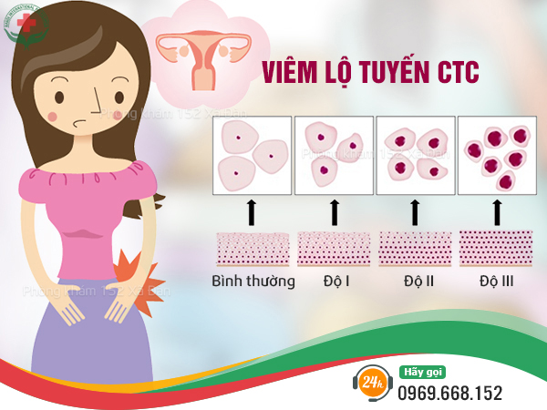 viêm lộ tuyến cổ tử cung