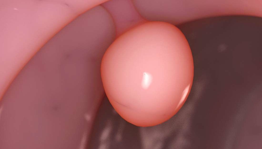 polyp âm đạo có nguy hiểm không