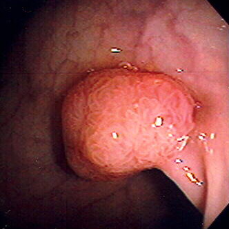 polyp âm đạo là gì