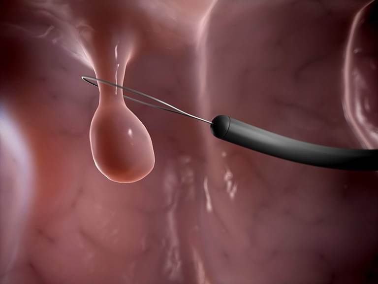 hình ảnh polyp âm đạo ở chị em phụ nữ