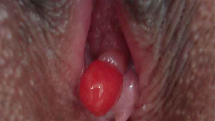 hình ảnh polyp âm đạo ở chị em phụ nữ