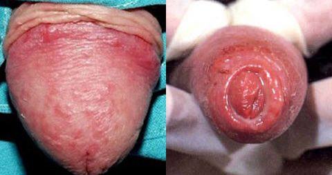 hình ảnh lỗ sáo bất thường