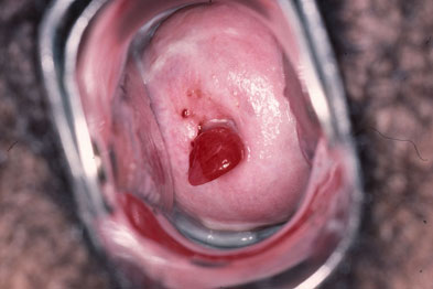 hình ảnh polyp cổ tử cung ở nữ giới chi tiết nhất