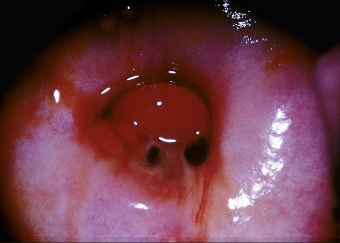 hình ảnh polyp cổ tử cung chi tiết nhất