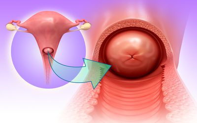 hình ảnh polyp cổ tử cung chi tiết nhất