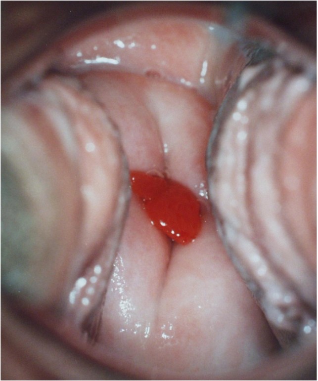 hình ảnh polyp cổ tử cung ở nữ giới chi tiết nhất