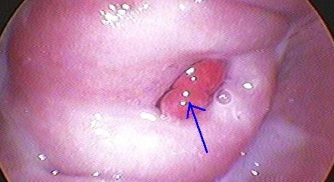 Xoắn polyp cổ tử cung khi đang mang thai