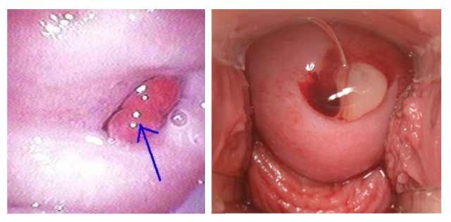 Xoắn Polyp cổ tử cung khi đang mang thai có ảnh hưởng gì không
