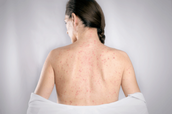 Con đường lây nhiễm của bệnh giang mai