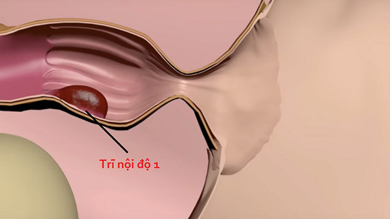 hình ảnh bệnh trĩ nội và trĩ ngoại qua các giai đoạn 1 2 3