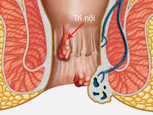Hình ảnh bệnh trĩ nội và trĩ ngoại chi tiết qua các cấp độ 1 2 3