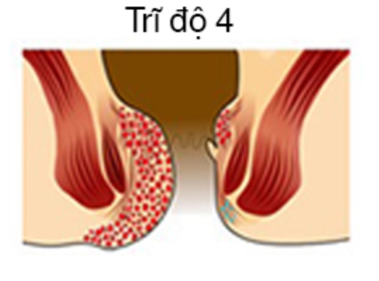 hình ảnh bệnh trĩ nội và trĩ ngoại