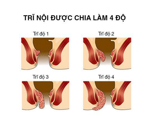 hình ảnh bệnh trĩ nội và trĩ ngoại qua các cấp độ