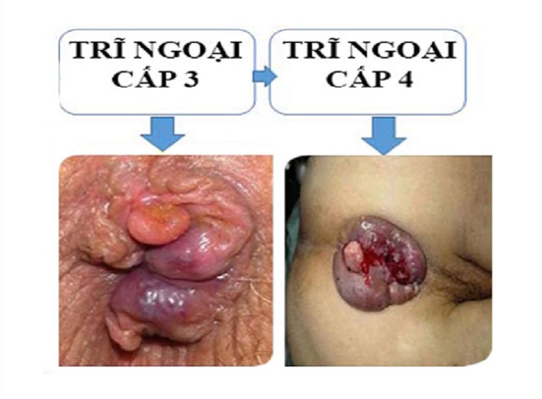 hình ảnh bệnh trĩ ngoại và trĩ nội qua các cấp độ 1 2 3