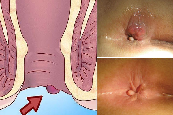 hình ảnh bệnh trĩ ngoại và trĩ nội chi tiết nhất