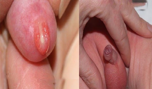 Hình ảnh viêm bao quy đầu ở người lớn và trẻ em