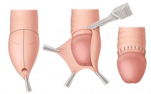 cắt bao quy đầu bao lâu thì hết sưng