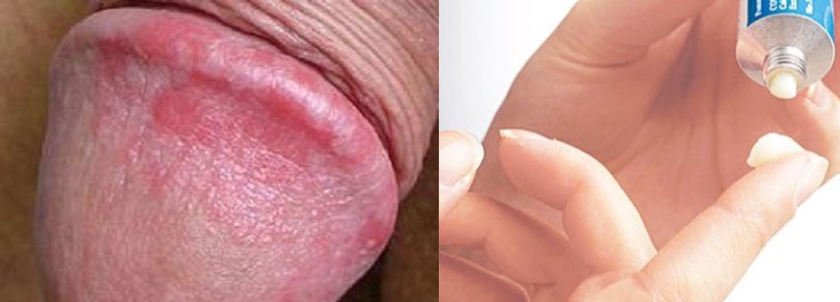 hình ảnh viêm bao quy đầu ở người lớn và trẻ em