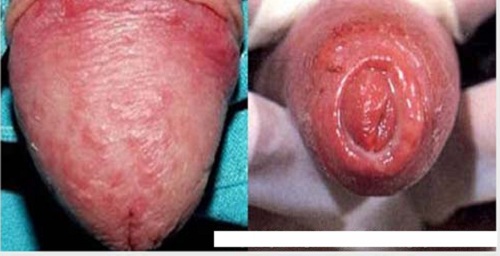hình ảnh viêm bao quy đầu ở người lớn và trẻ em