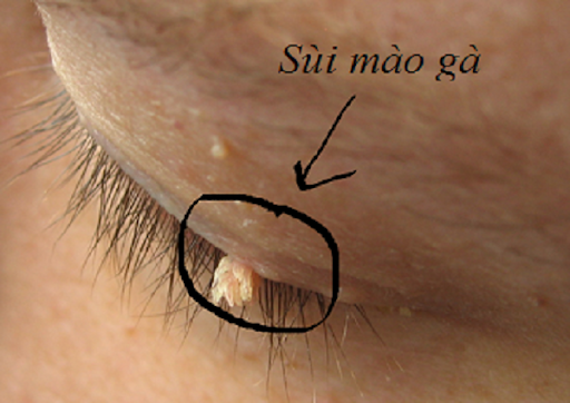 sùi mào gà ở mắt là do đâu