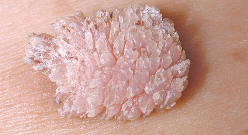 sùi mào gà ở mắt có triệu chứng gì
