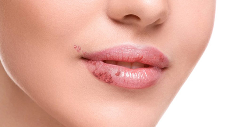 hình ảnh bệnh sùi mào gà ở miệng