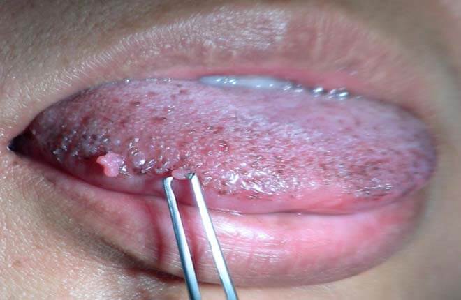 hình ảnh sùi mào gà ở miệng