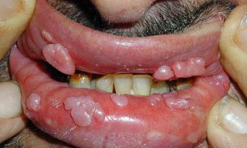 hình ảnh sùi mào gà ở miệng qua từng giai đoạn